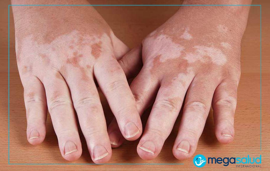 Artritis reumatoide